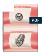 Clasificacion de Defectos Oseos Adyacentes A Implantes - En.es