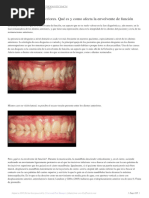 Desgaste en Dientes Anteriores Qué Es y Como Afecta La Envolvente-Comprimido PDF