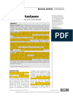 Brain Metastases: Review Article