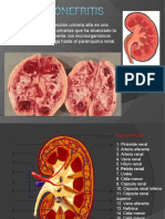 Pielonefritis