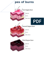 Types of Burns