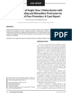 Management of Angle Class I Malocclusion With Severe Crowding and Bimaxillary Protrusion by Extraction of Four Premolars A Case Report