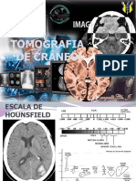 Tomografia de Craneo