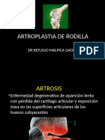 Artroplasria Total de Rodilla