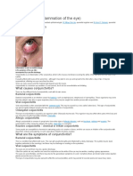 Conjunctivitis (Inflammation of The Eye)