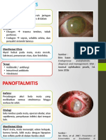 Endoftalmitis and Panoftalmitis