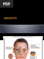 Sinusitis