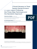 Palatal and Facial Veneers To Treat