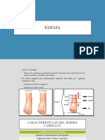 Edema