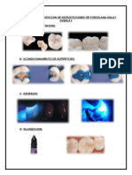 Protocolo de Cementacion de Incrustaciones de Porcelana