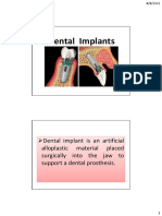 Dental Implants