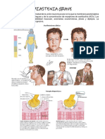 Miastenia Grave