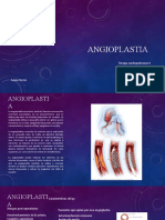 Angioplastia