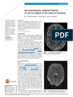 Decreased Consciousness Bithalamic Infarc