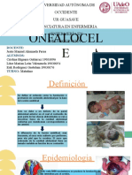 ONFALOCELE 