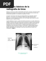 Aspectos Básicos de La Radiografía de Tórax