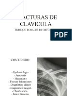 Fracturas Clavicula