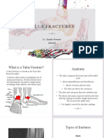 Talus Fractures