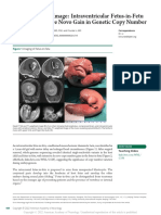 Teaching Neuroimage: Intraventricular Fetus-In-Fetu With Extensive de Novo Gain in Genetic Copy Number