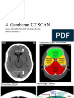 Gambaran CT EDH SDH SAH ICH IVH CI