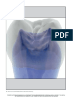 Magne 2009 CT Scan Based Finite Element Analysis of Premolar Cuspal