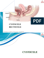 Cystocele & Rectocele