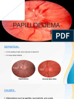 Papilloedema 71