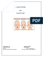 Case Study On Cleft Lip by Me