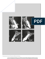 Buccal-Lingual Bone Remodeling in Immediately Loaded Fresh Socket Implants A Cone Beam Computed Tomography Study