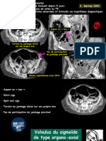 Volvulus Sigmoide