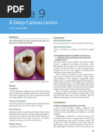 Case - Deep Caries