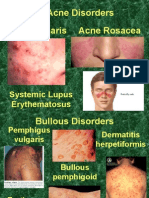 Acne Vulgaris Acne Rosacea Acne Disorders: Systemic Lupus Erythematosus