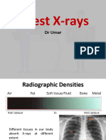 Chest Xray