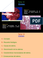 Edema