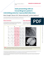 Mimicking Stemi in Cardiac Metastasis Esc