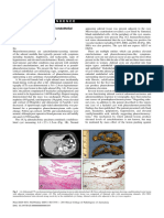 First Report of Adrenal Cortical Endothelial (Vascular) Cyst Mimicking Phaeochromocytoma (Pseudophaeochromocytoma