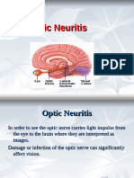 Optic Neuritis