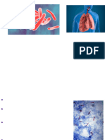 Pulmonary tuberculosis