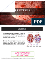 Presentación1 leucemia