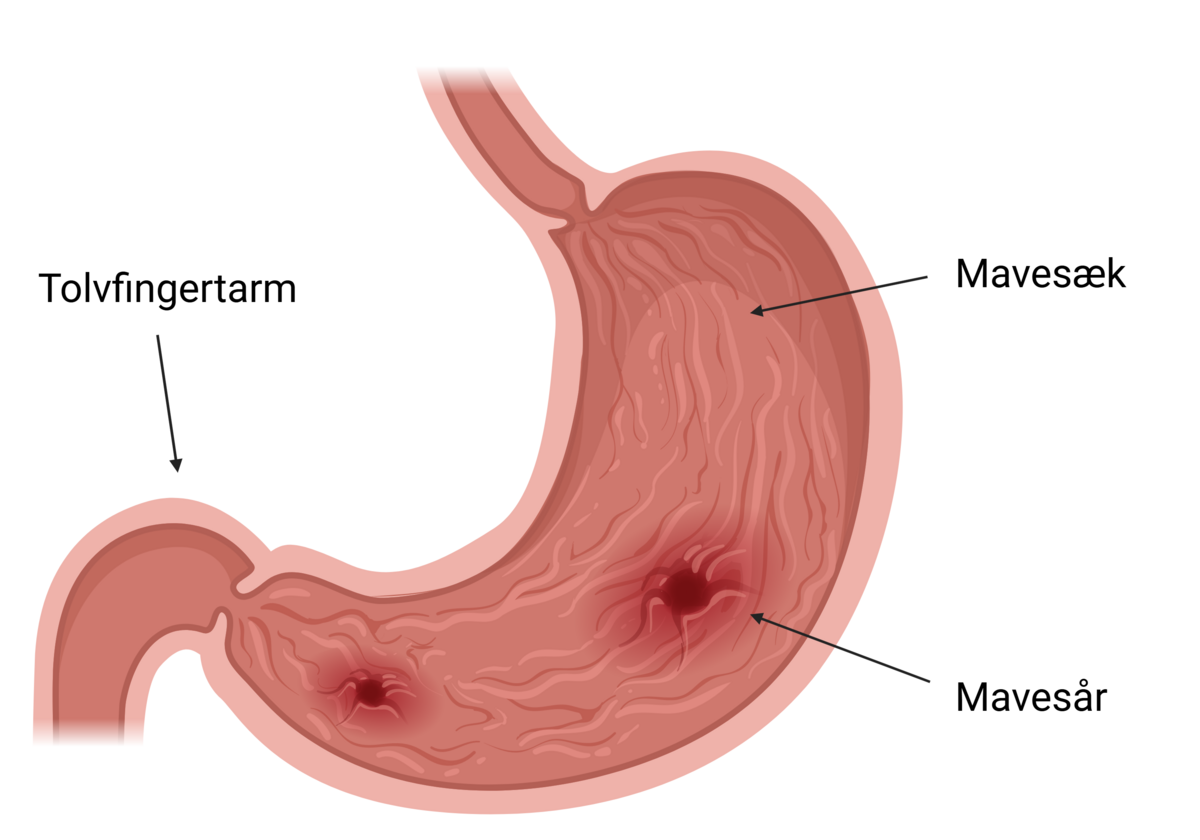 Illustration af mavesår