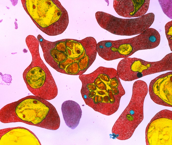 Transmission electron micrograph of a section through red blood cells infected with the malaria parasite, coloured in pink, red and yellow.