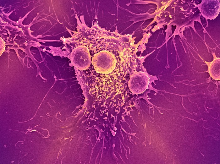 Coloured scanning electron micrograph of T lymphocyte cells attached to a cancer cell in purple and yellow colours