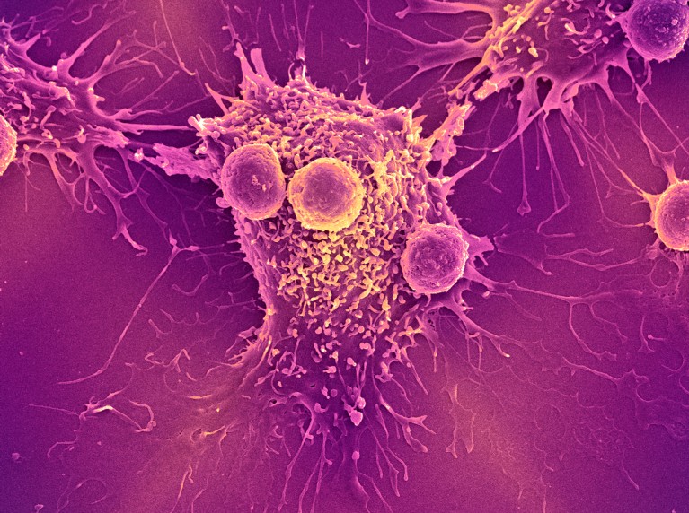 Coloured scanning electron micrograph of T lymphocyte cells attached to a cancer cell in purple and yellow colours