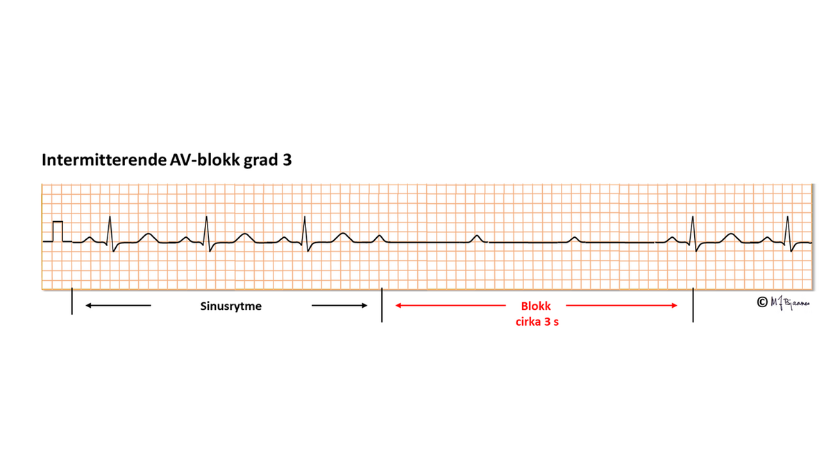 AV-blokk grad 3