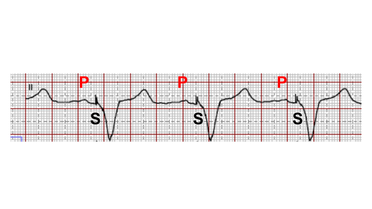 Atriestyrt pacing av hovedkamrene