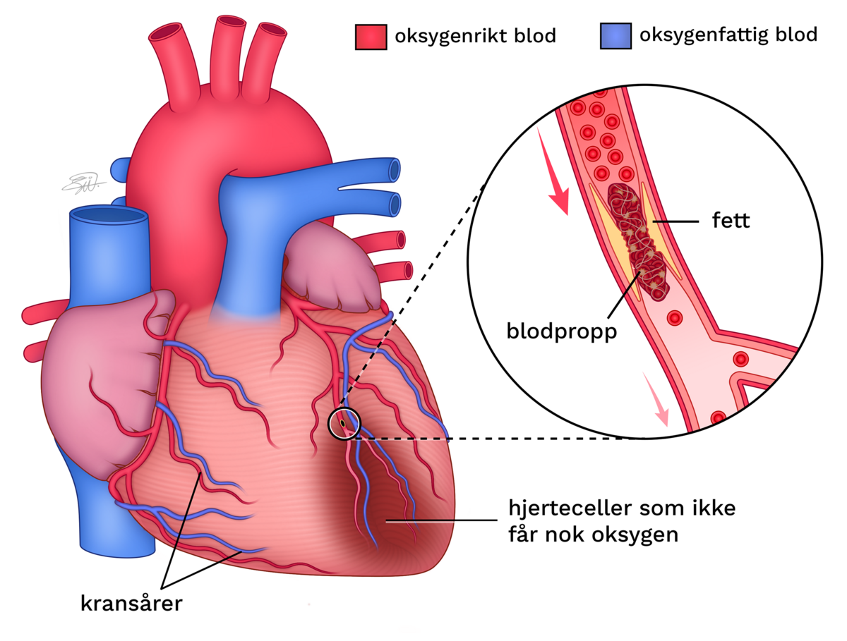 En tegning av et hjerte med fremhevede kransårer. Kransårene går ut av hovedpulsåren på toppen av hjertet og forgrener seg og blir smalere lenger nedover. I en av kransårene er det en blodpropp. Åren er blek nedenfor proppen. Området av hjertet som ikke får blod er blitt mørk, som tegn på oksygenmangel. Et nærbilde av innsiden av kransåren viser at det er fett i veggene og at åren er trang. Fettet har kommet i kontakt med blodet og det er dannet en blodpropp. Proppen er mørk og stenger åren, slik at røde blodceller som frakter oksygen ikke får kommet forbi.