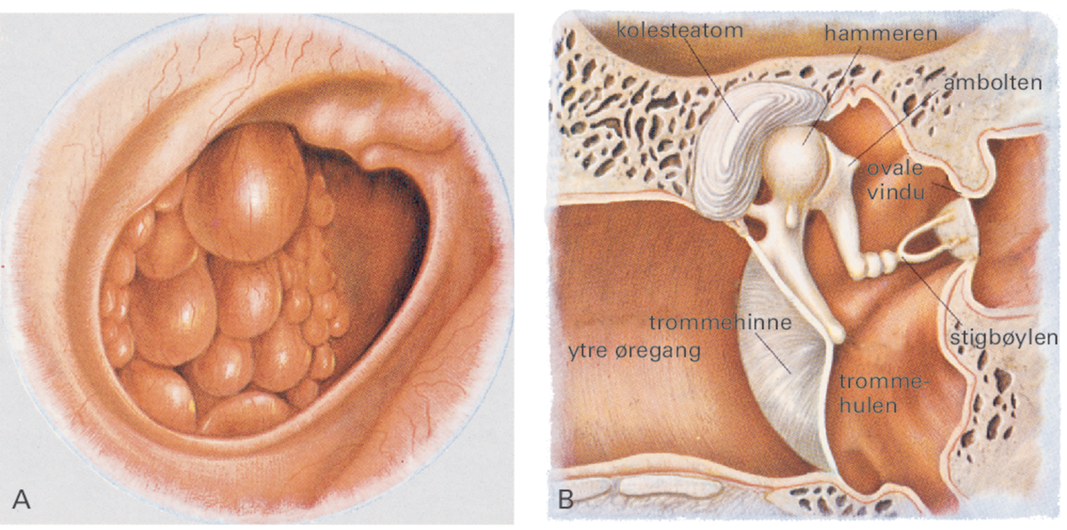 Mellomørebetennelse.