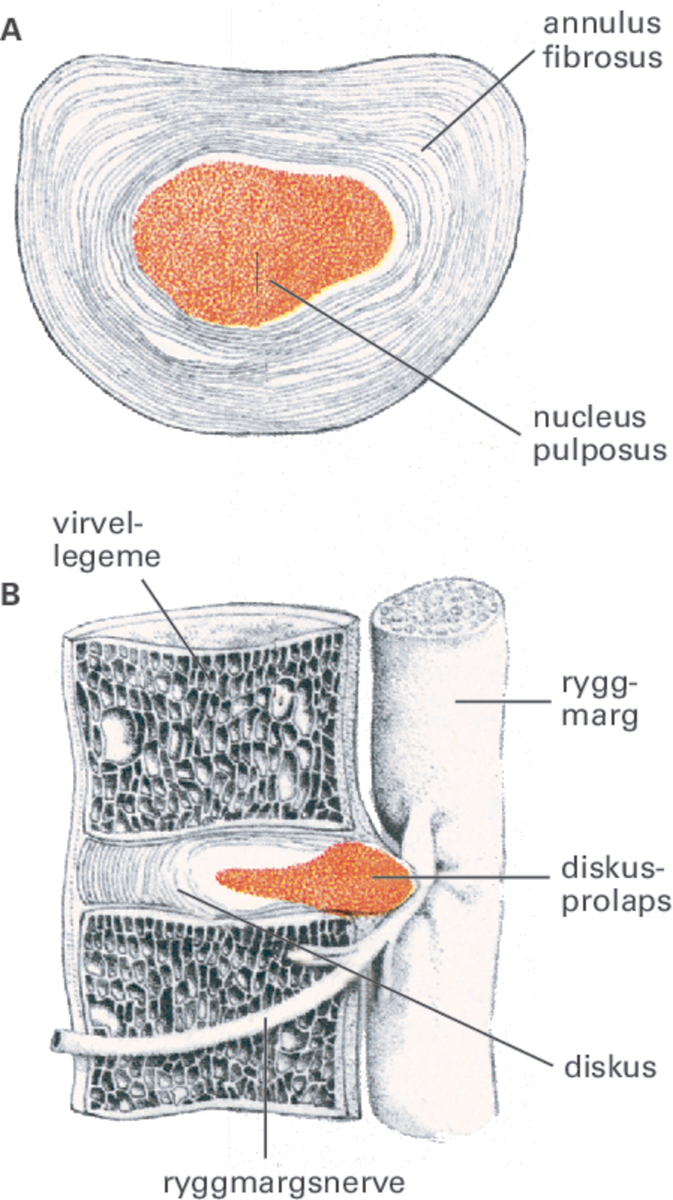 Diskusprolaps.