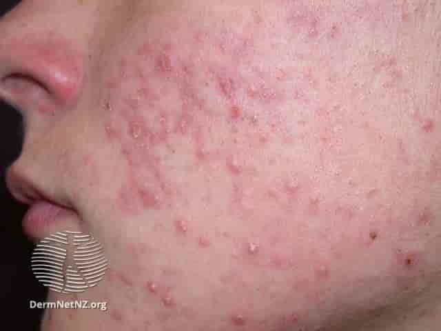 Acne vulgaris