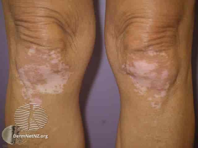 Vitiligo